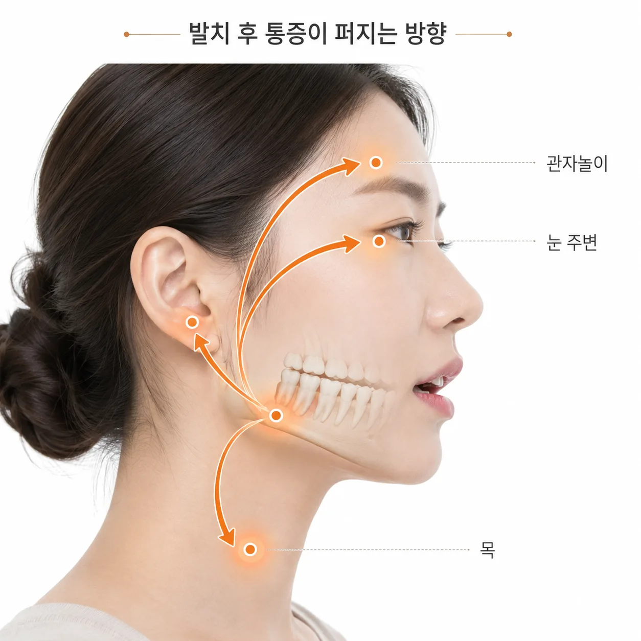 발치 부위에서 같은 쪽 귀와 관자놀이, 눈, 목 방향으로 통증이 퍼지는 경로를 표시한 도해
