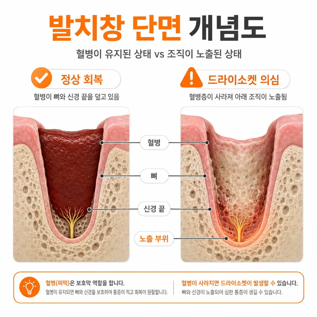 발치 자리에서 혈병이 뼈와 신경을 덮고 있는 상태와 그 층이 사라진 상태를 비교한 단면 개념도