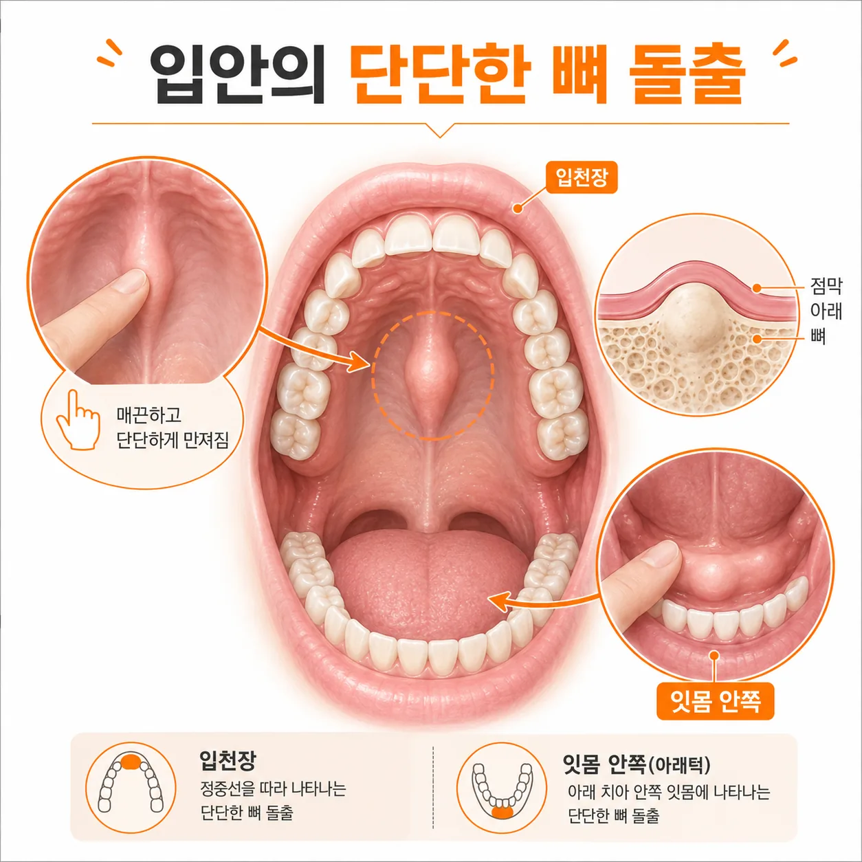 잇몸과 입천장에 단단한 뼈가 만져지는 상태를 설명한 개념 도식 이미지
