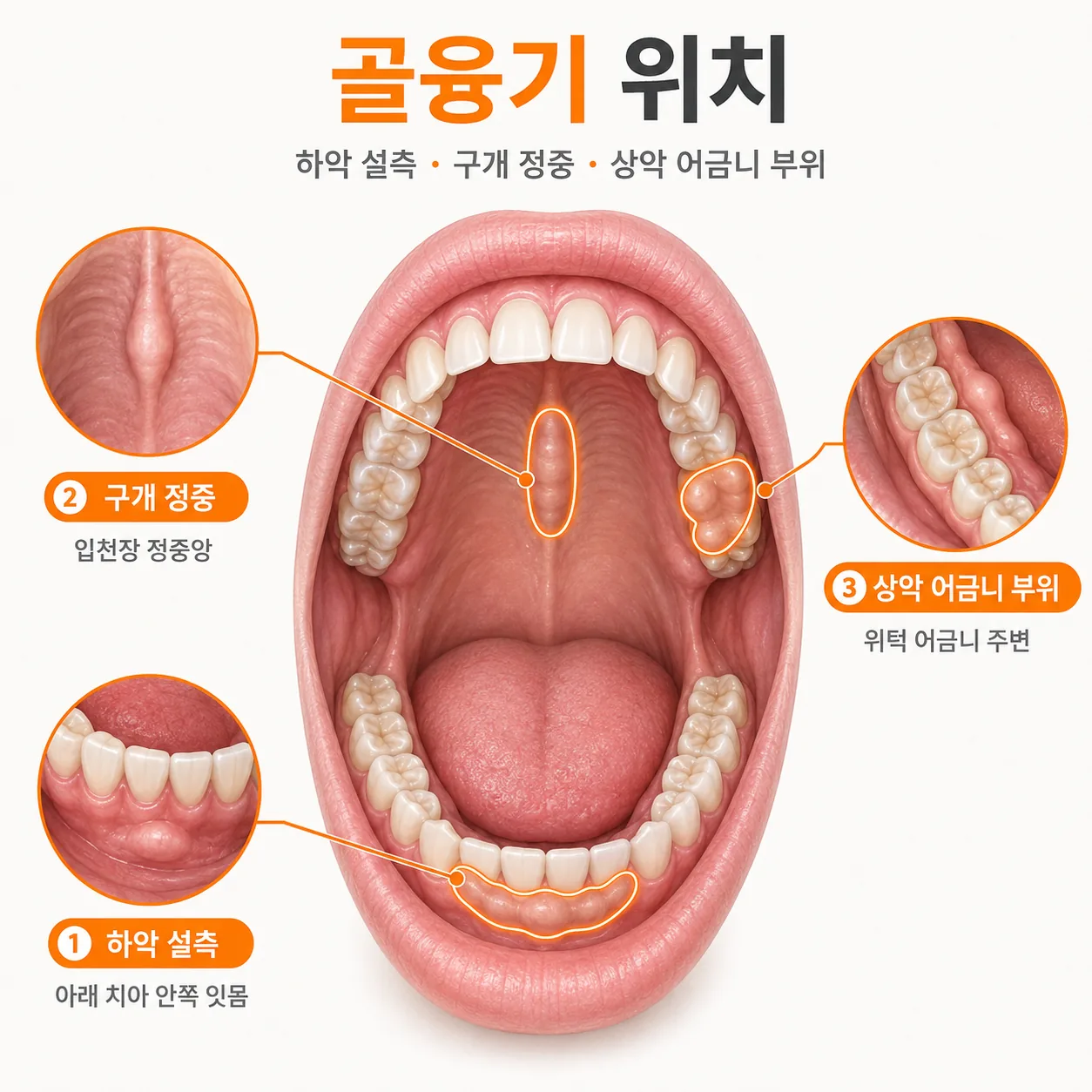 하악 안쪽과 입천장 정중앙, 위턱 어금니 부위로 골융기 위치를 나눈 도식 이미지