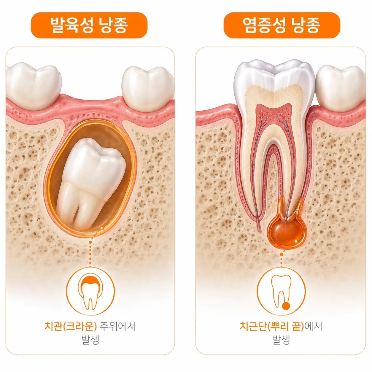 발육성 낭종과 염증성 낭종 차이 비교 일러스트