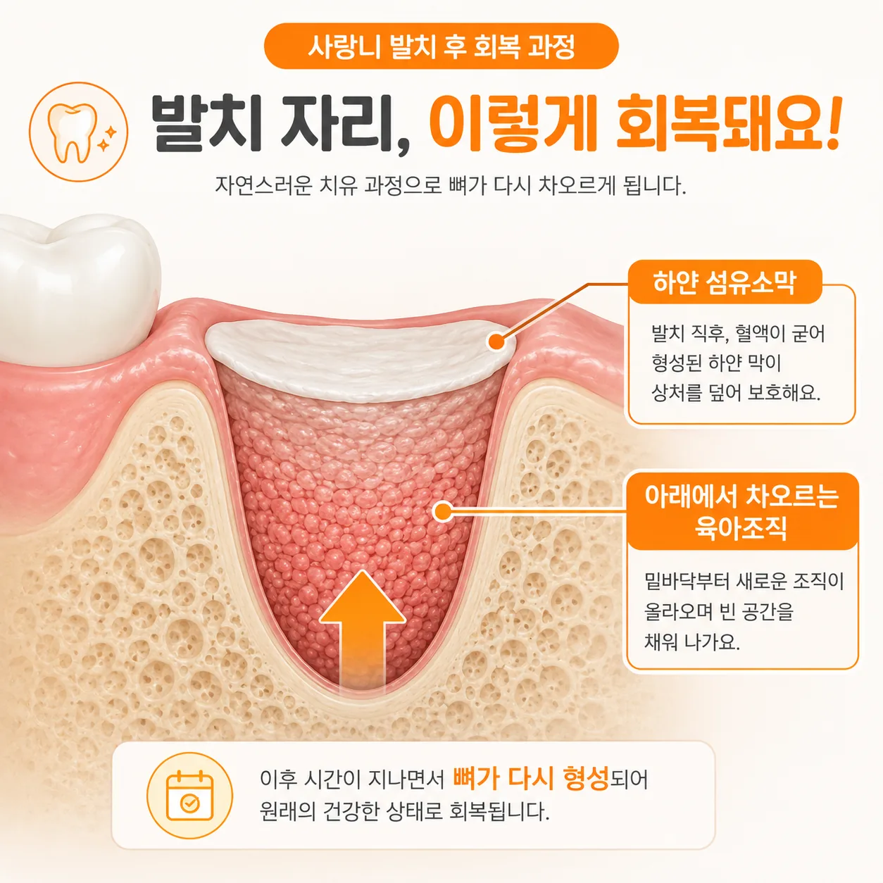 사랑니 발치 후 하얀 막과 새살이 자리 잡는 층 구조 도해