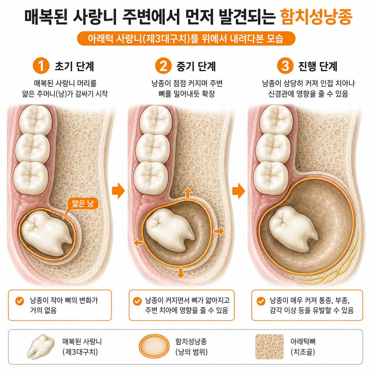 매복된 사랑니 머리를 감싼 함치성낭종이 커지는 과정을 단계별로 나타낸 도식