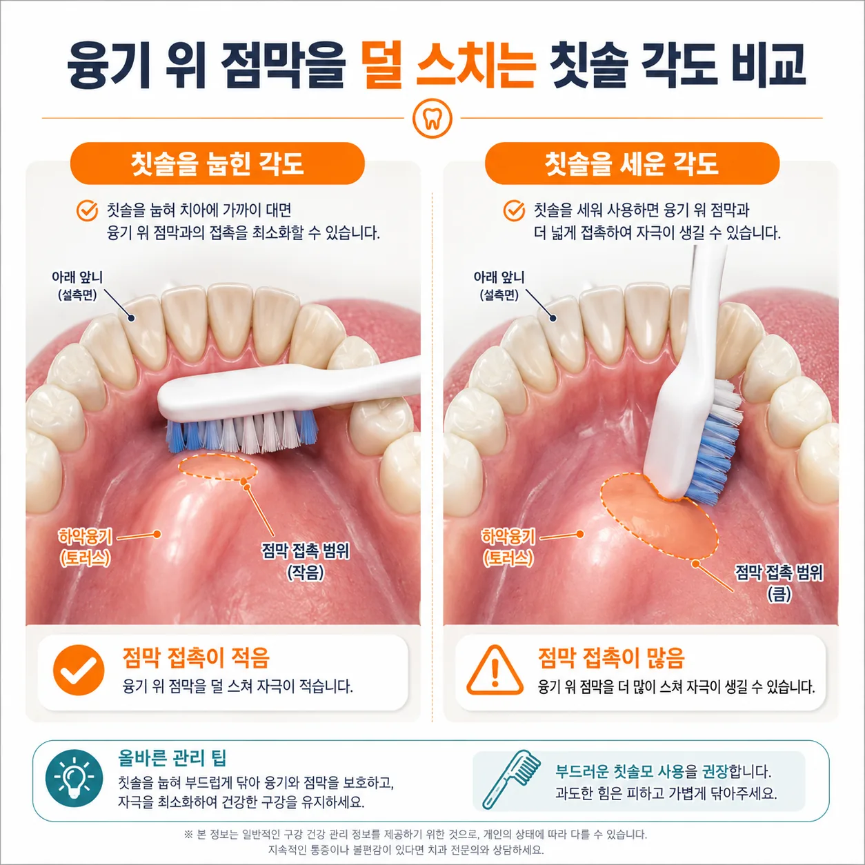 융기 위 점막을 덜 스치는 칫솔 각도 비교