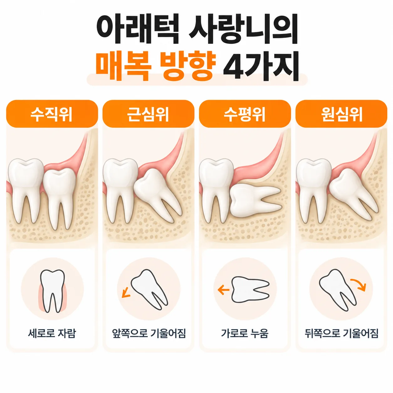 아래턱 사랑니의 수직위·근심위·수평위·원심위 매복 방향을 비교한 도해