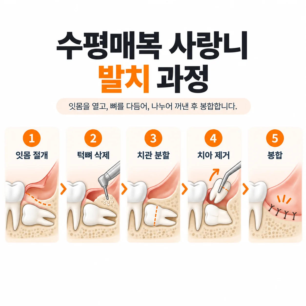 수평매복 사랑니 발치의 절개·턱뼈 삭제·치관 분할·제거·봉합 단계를 나타낸 도해