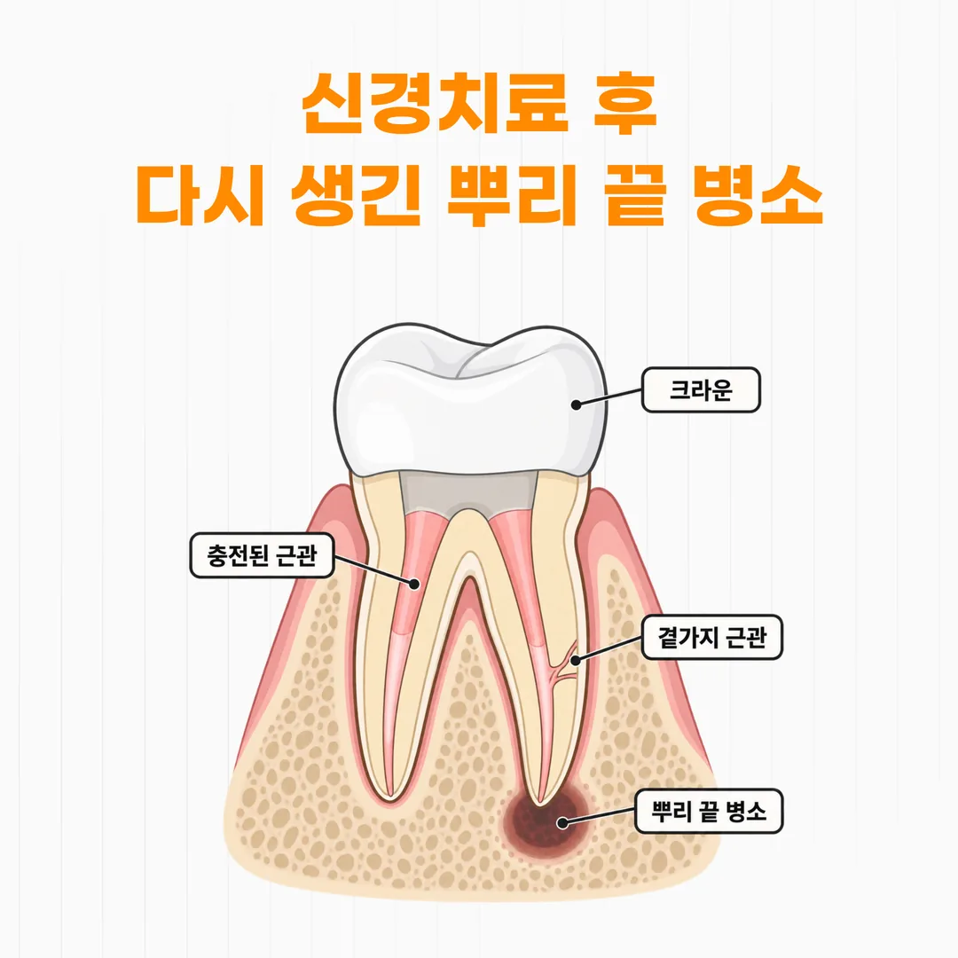 신경치료한 어금니 뿌리 끝 병소와 곁가지 근관 개념도