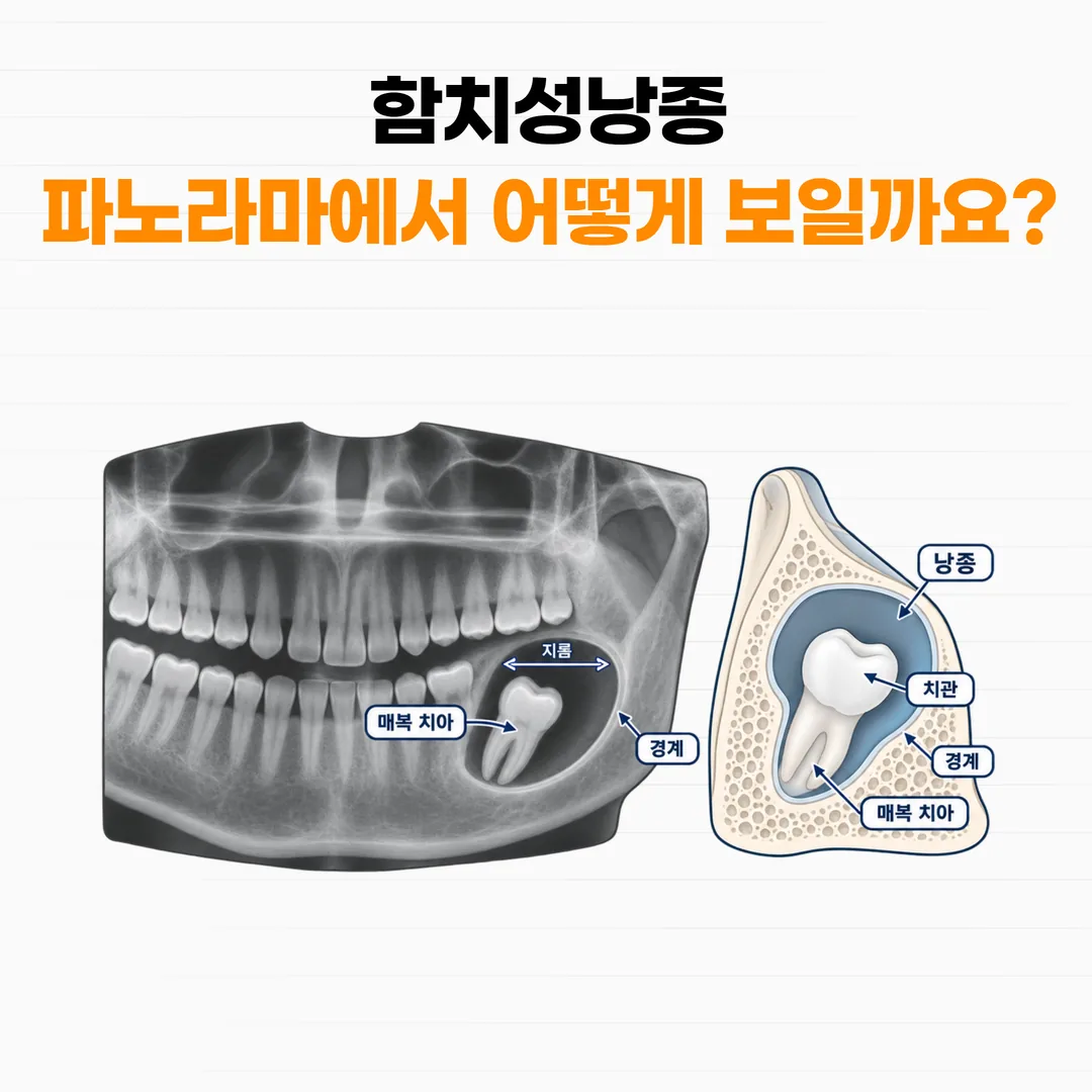 함치성낭종의 방사선 소견을 설명한 개념도