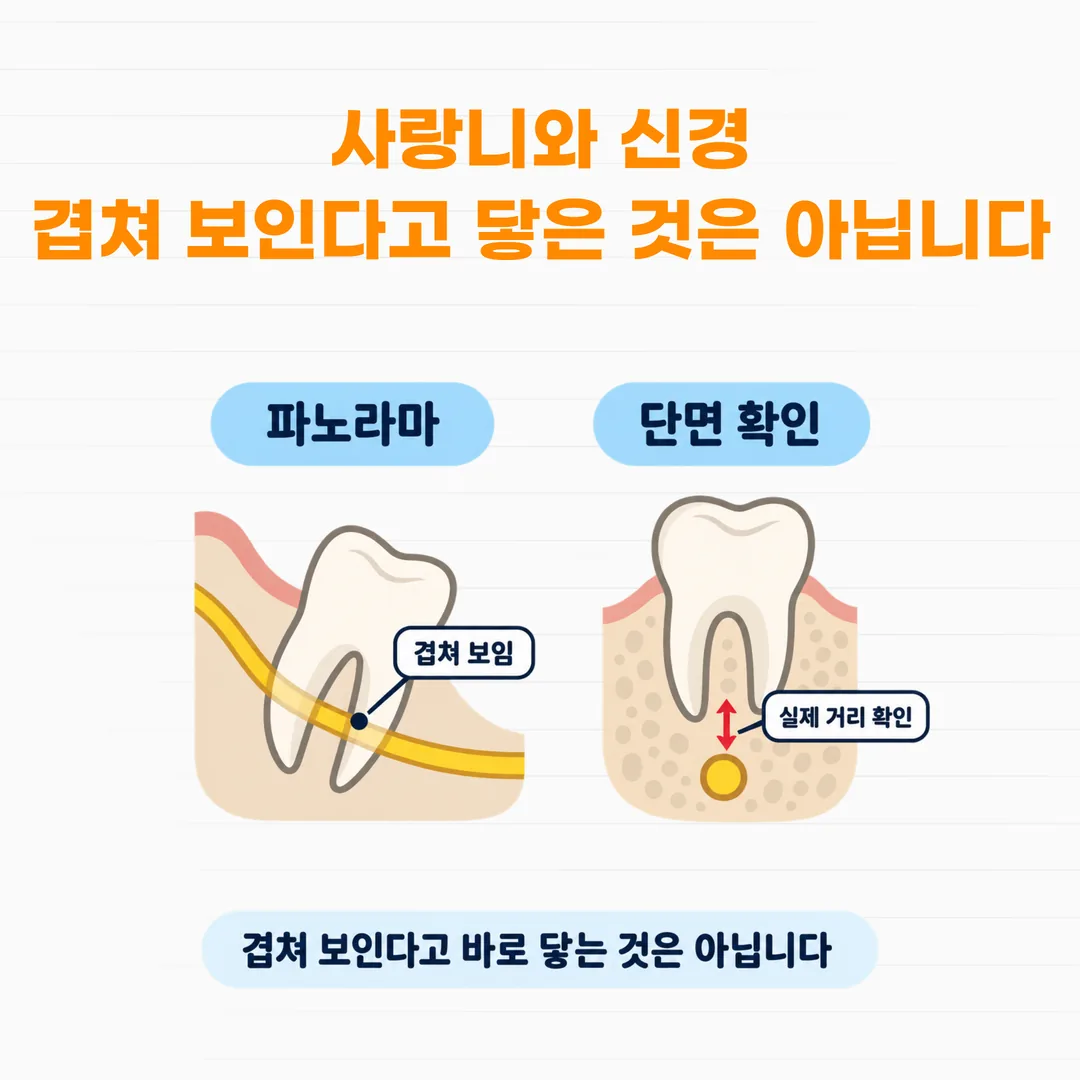 사랑니 뿌리와 하치조신경관이 겹쳐 보이는 평면 영상과 단면에서 확인한 실제 위치를 비교한 개념도