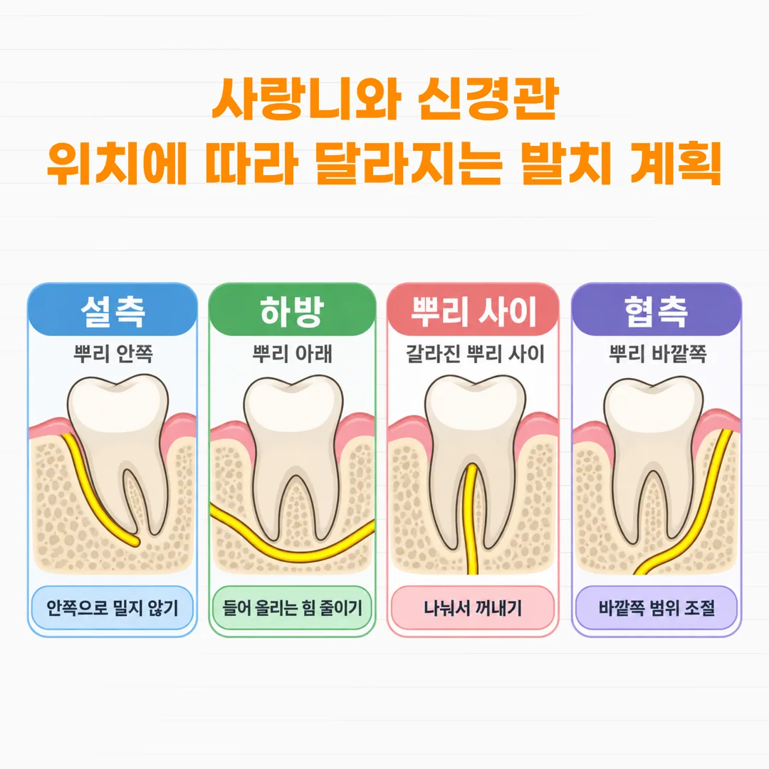 치과용 CT 관상면에서 하치조신경관이 사랑니 뿌리의 설측, 하방, 뿌리 사이, 협측에 위치하는 네 가지 유형을 나눈 관계도