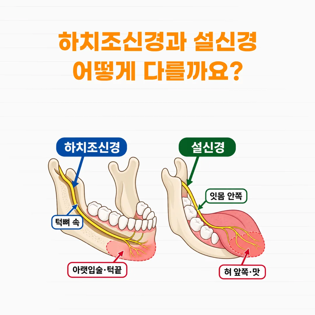 하치조신경은 아래턱뼈 속 신경관을, 설신경은 뼈 바깥 잇몸 안쪽을 지나며 각각 아랫입술과 턱끝, 혀 앞부분의 감각을 담당함을 보여주는 아래턱 모식도