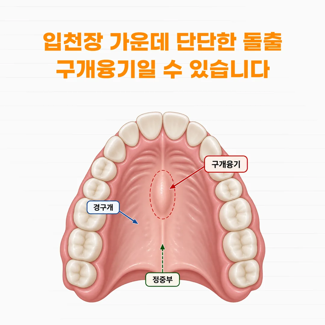 입천장 한가운데 경구개 정중부에 자리한 구개융기의 위치를 표시한 구강 구조 일러스트