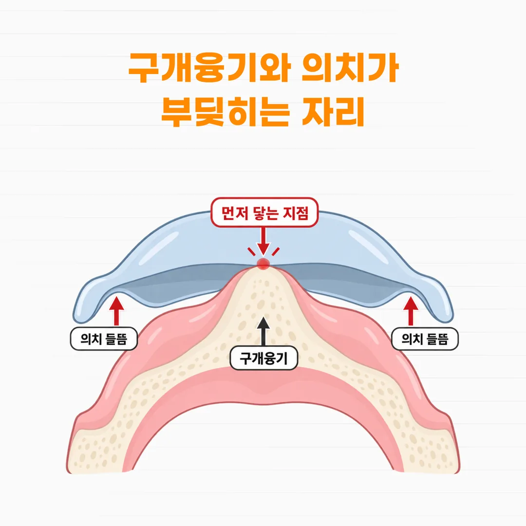구개융기 때문에 의치 안쪽 면이 한 점에 먼저 닿아 장치가 들뜨는 지점을 표시한 단면 도식
