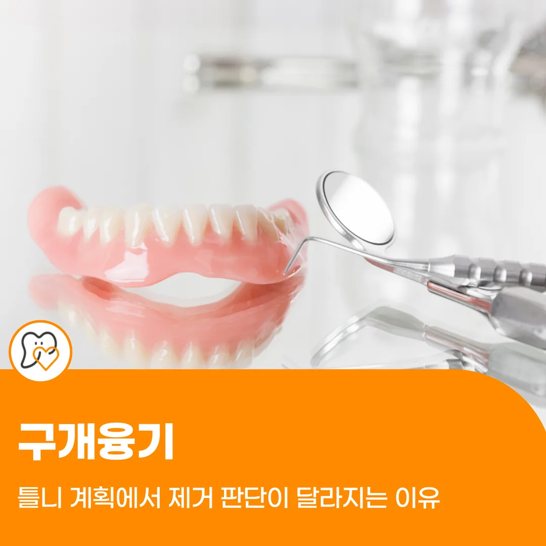 구개융기, 틀니 계획에서 제거 판단이 달라지는 이유