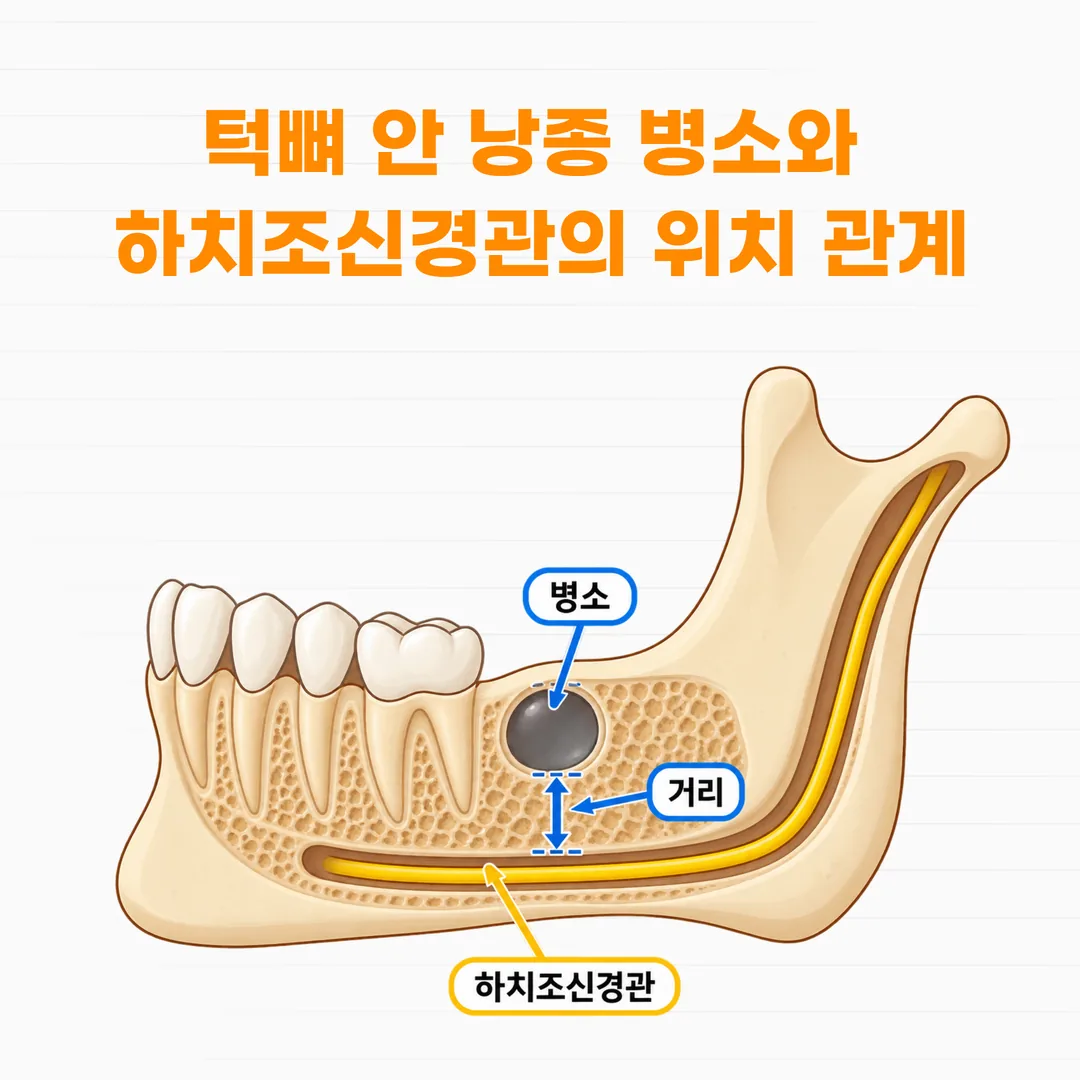 턱뼈 안에서 둥근 경계로 확인되는 낭종 병소와 신경관 위치 모식도